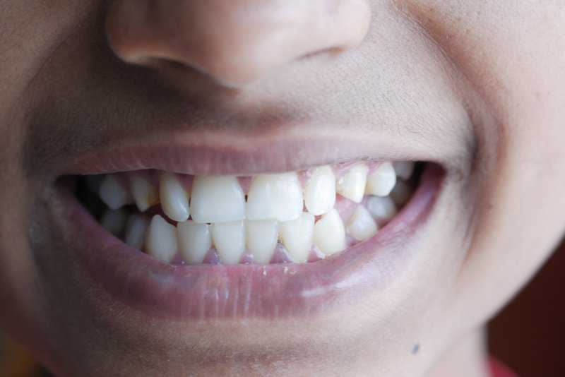 Ask Your Crownsville Dentist: Should I Use Mouthwash Regularly?