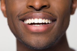 low cost invisalign