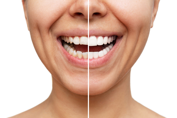 affordable veneers