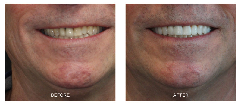 No Prep Veneers Before and After