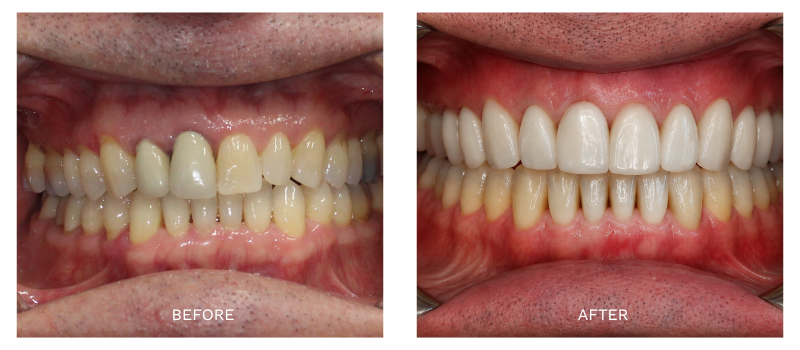Close Up No Prep Veneers